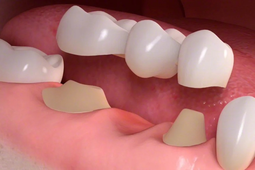 Dental bridge install procedure